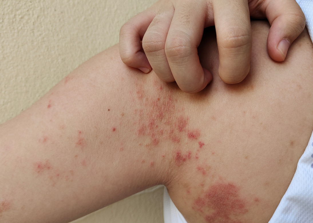 Chronic Skin Conditions